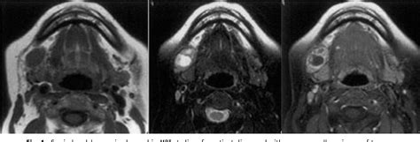 Figure 1 From Significance Of Cervical Node Necrosis In Preoperative