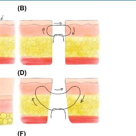 Intradermal Butterfly Suture A Suture Path Of A Single Intradermal Download Scientific