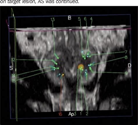 Figure From Mri Us Fusion Prostate Biopsy In Men On Active