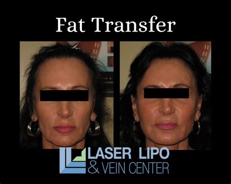 Can I Do Laser After Fat Transfer To Face Store