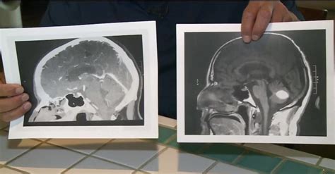 Tumor No C Rebro De Homem Some Sem Explica O Dia Antes Da Cirurgia