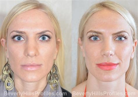 Revision Rhinoplasty Before And After Photos Beverly Hills La Rhinoplasty