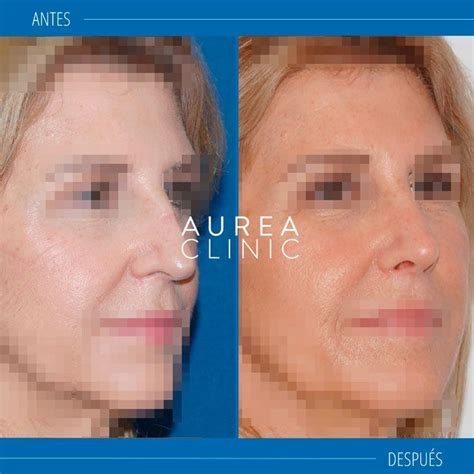 Rinoplastia Sevilla Para Tu Operaci N De Nariz Aurea Clinic