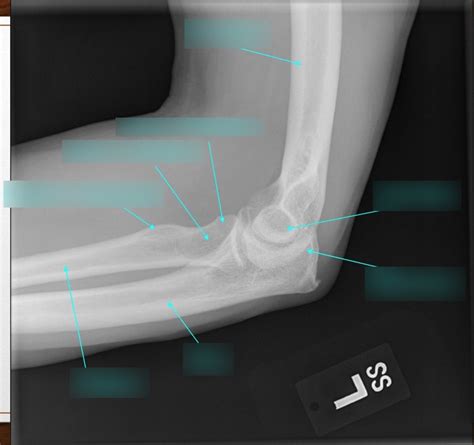 Lateral Elbow Anatomy Diagram Quizlet