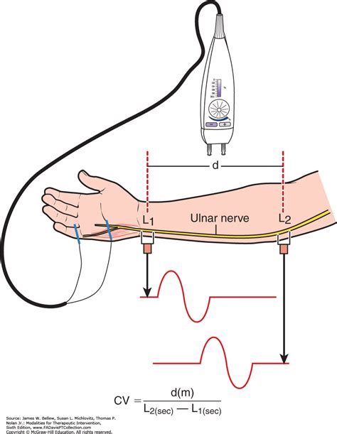 Eletroneuromiografia Enmg Clinica Regenerati Neurologia