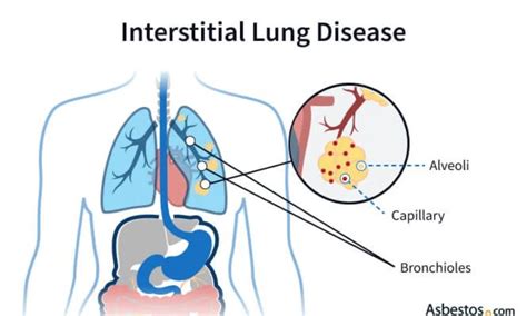 How Is ILD Diagnosed And Managed FITPAA