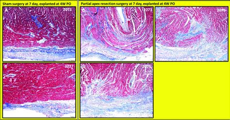 Partial Apex Resection Surgery At Seven Days And Heart Explanted At 4W