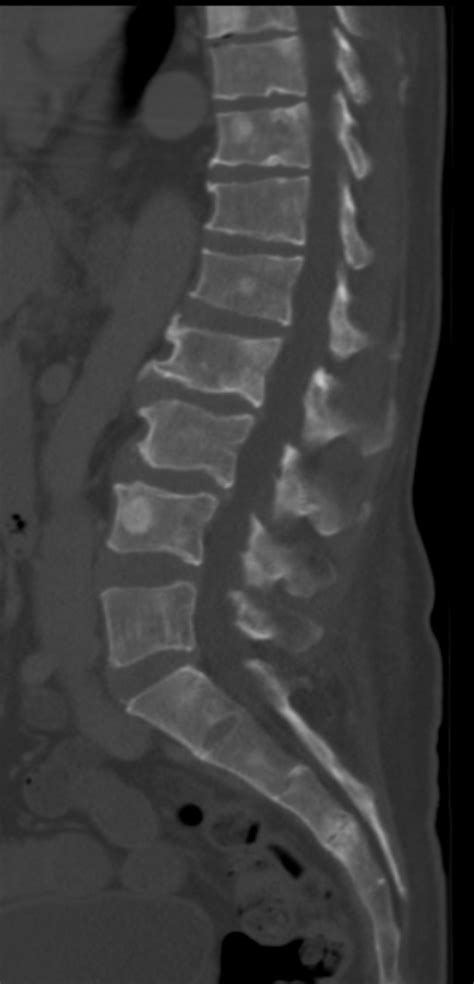 File:CT of osteoblastic lesions of multiple myeloma.jpg - Wikipedia