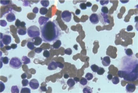 Megakaryocyte In Bone Marrow