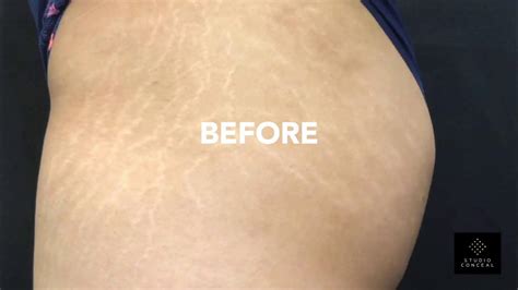 Brazilian Stretch Mark Camouflage Tattoo Journey Youtube