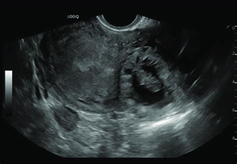 Ultrasound Of Interstitial Ectopic Pregnancy Measuring 9 Weeks