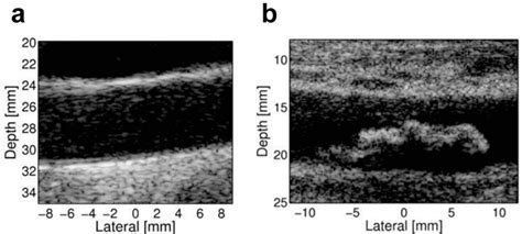 Ijms Free Full Text Ultrasound Imaging For Risk Assessment In Atherosclerosis