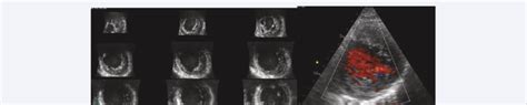 Transthoracic Echocardiography At Day A D Apical View Severe Lv