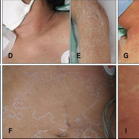 Diffuse Erythematous Eruption With Nonfollicular Pinhead Sized Pustules