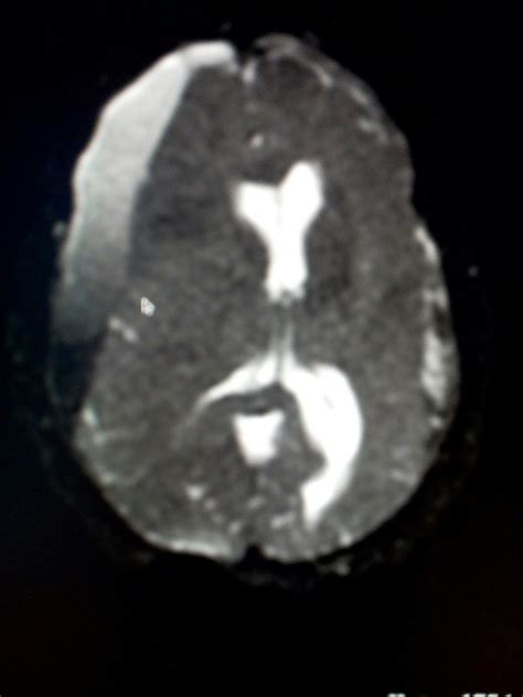 Radiodiagnóstico RMN Cerebral Hematoma subdural