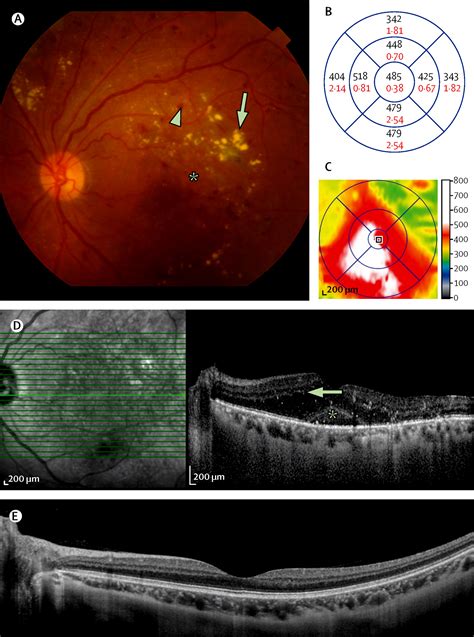 Diabetic Macular Oedema The Lancet Diabetes And Endocrinology