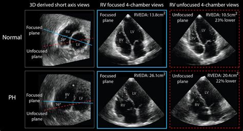 Example Of Right Ventricular Focused And Unfocused Apical Chamber