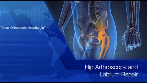 Hip Arthroscopy And Labrum Repair Dr Gombera Youtube