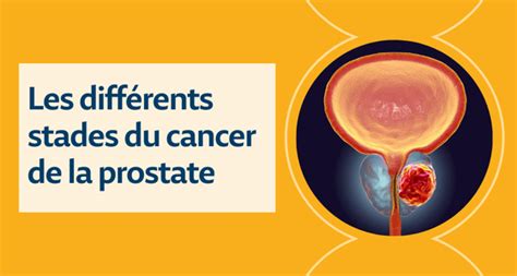 Cancer De La Prostate Stade 2 3 4 Diagnostic Et Traitement