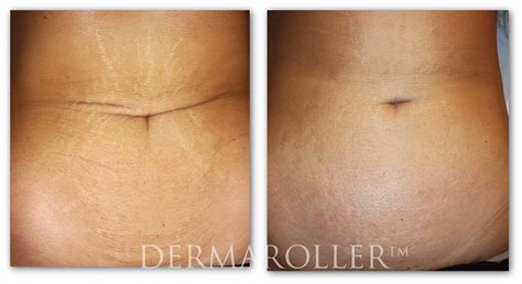 Dermarolling Before And After Stretch Marks