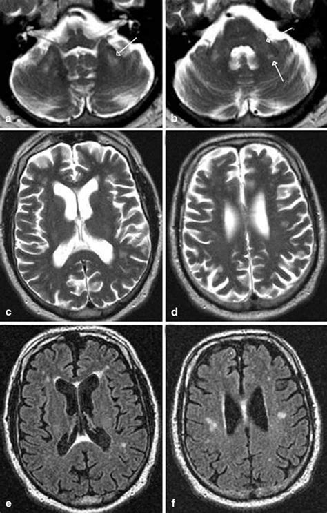 Friedreich Ataxia Mri