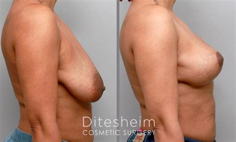 Fat Transfer Breast Augmentation