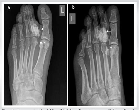 Figure From Bizarre Parosteal Osteochondromatous Proliferation Nora