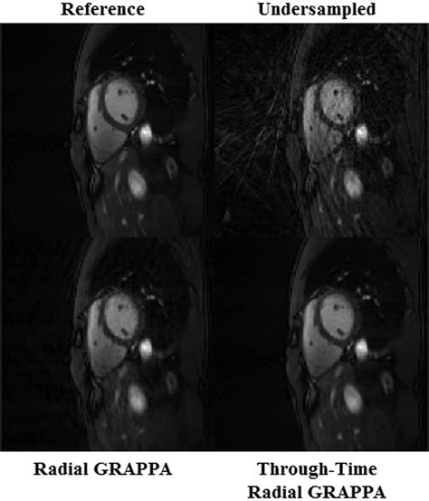 NonCartesian Parallel Imaging Reconstruction Wright 2014 Journal