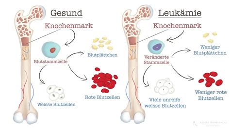 Leukämie Symptome Ursachen Diagnostik Behandlung Alpine BioMedical