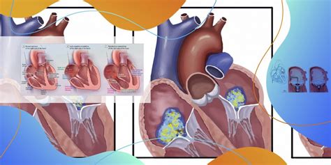 Aprenda Sobre O Estenose Mitral Cl Nico Thevalveclub