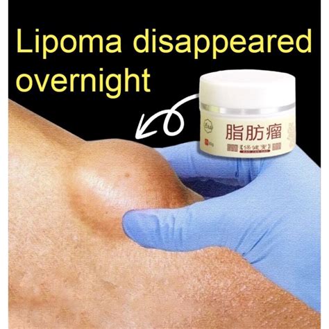 Original Lipoma Removal Cream Special Gel Removing Multiple