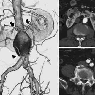 Preoperative Contrast Enhanced Computed Tomography CT A