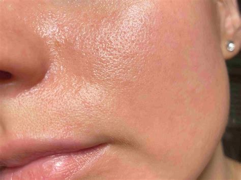 Enlarged Pores Causes And Treatments