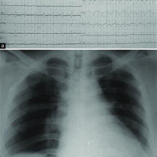 A Electrocardiography Showing Sinus Tachycardia With T Wave Inversion