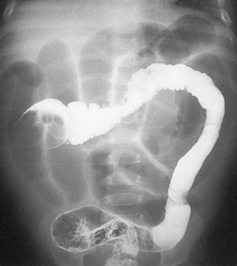 Intussusception Pediatric Diseases And Conditions 5minuteconsult