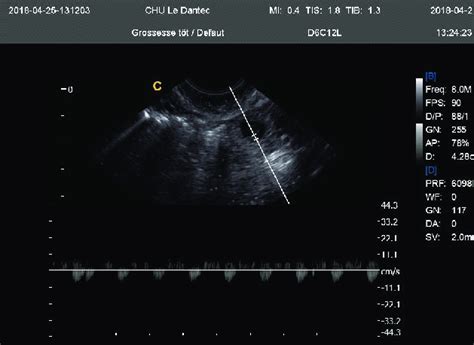 Endovaginal ultrasound showing ectopic pregnancy. | Download Scientific ...