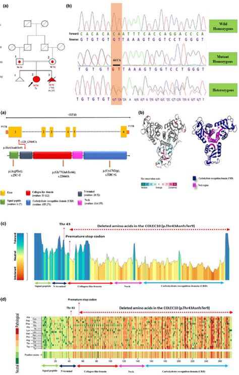 Wholeexome Sequencing Identified First Homozygous Frameshift Variant