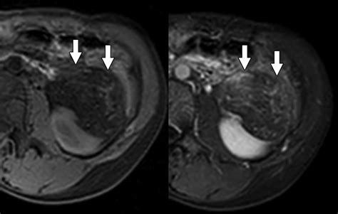 Renal Angiomyolipoma Radiologic Classification And Imaging Features