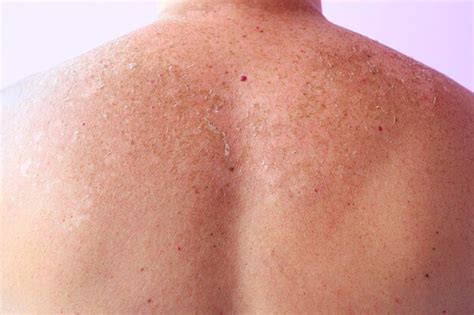 Premium Photo Traces Of Sunburn On The Back Of A Man Human Skin After