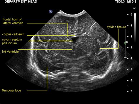 Practical Guide To Neonatal Cranial Ultrasound Crus Basics