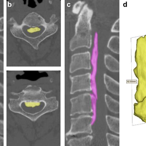 A A Midsagittal Computed Tomography CT Image Of A 58 Year Old Man