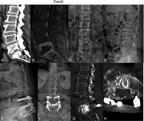 A 70 Year Old Female Was Diagnosed As Having Tuberculous Spondylitis