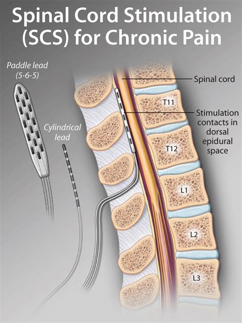 Spinal Cord Stimulation An Under Utilized And Under Recognized Pain