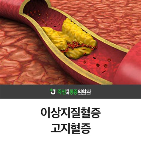 대구 기능의학클리닉이상지질혈증 고지혈증 네이버 블로그