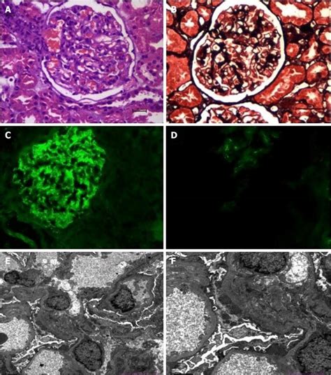 Renal Biopsy Findings A And B Mesangial Hypercellularity Was Mild