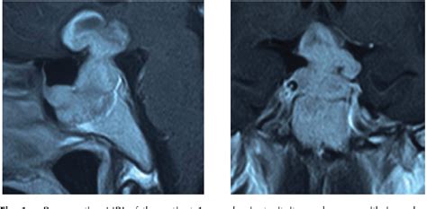 Figure 1 From Management Of Large And Giant Pituitary Adenomas With