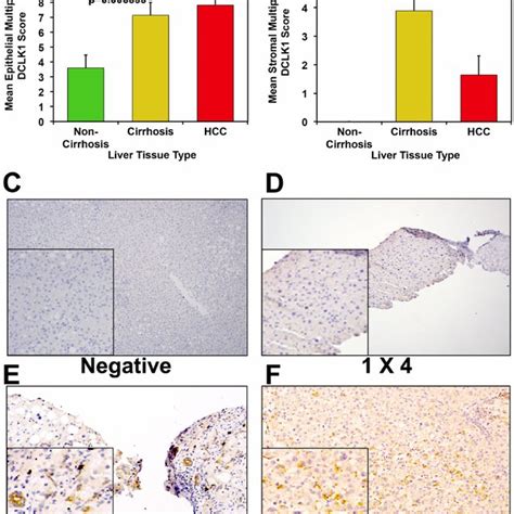 Sirna Mediated Knockdown Of Dclk1 Results In Human Liver Tumor