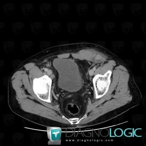 Cas Radiologie Liposarcome Scanner IRM Diagnologic