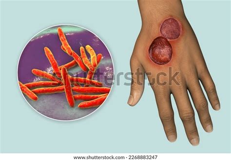 Buruli Ulcer Chronic Debilitating Disease Affecting Stock Illustration