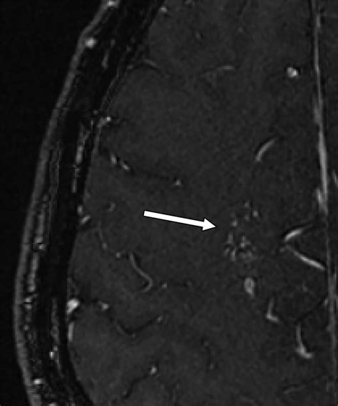 Contemporary Imaging Of Cerebral Arteriovenous Malformations Ajr